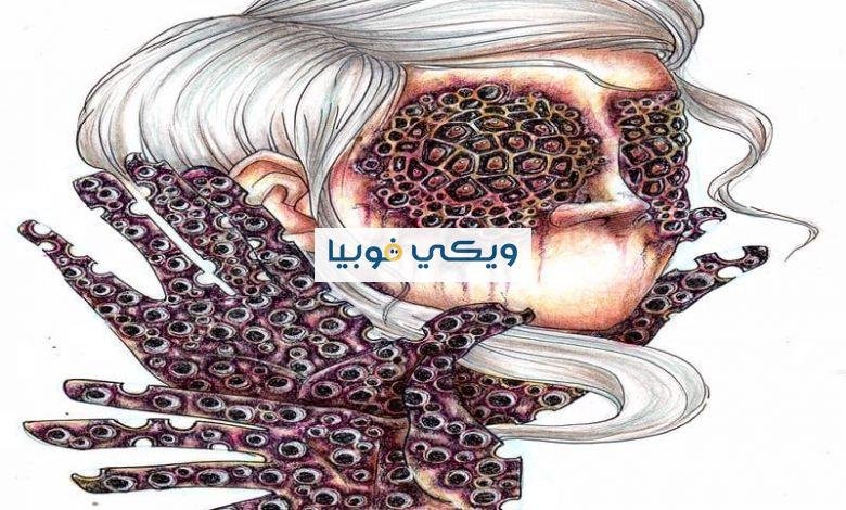 فوبيا النخاريب: دليل شامل عن أعراضها ومثيراتها وطرق علاجها فوبيا النخاريب
